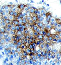 BRCA1 was detected in immersion fixed paraffin-embedded sections of human breast cancer tissue using 5 µg/mL Goat Anti-Human BRCA1 Antigen Affinity-purified Polyclonal Antibody (Catalog # AF2210) overnight at 4 °C. Tissue was stained with the Anti-Goat HRP-DAB Cell & Tissue Staining Kit (brown; Catalog # CTS008) and counterstained with hematoxylin (blue). View our protocol for Chromogenic IHC Staining of Paraffin-embedded Tissue Sections.