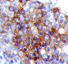 BRCA1 was detected in immersion fixed paraffin-embedded sections of human breast cancer tissue using Sheep Anti-Human BRCA1 C-Terminus Antigen Affinity-purified Polyclonal Antibody (Catalog # AF6955) at 5 µg/mL overnight at 4 °C. Tissue was stained using the Anti-Sheep HRP-DAB Cell & Tissue Staining Kit (brown; Catalog # CTS019) and counterstained with hematoxylin (blue). Specific staining was localized to the cytoplasm and plasma membranes of epithelial cells. View our protocol for Chromogenic IHC Staining of Paraffin-embedded Tissue Sections.