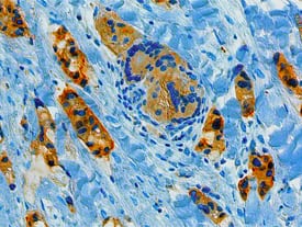 BRCA1 was detected in immersion fixed paraffin-embedded sections of human breast cancer tissue using Human BRCA1 Monoclonal Antibody (Catalog # MAB22101) at 5 µg/mL overnight at 4 °C. Before incubation with the primary antibody tissue was subjected to heat-induced epitope retrieval using Antigen Retrieval Reagent-Basic (CTS013). Tissue was stained using the Anti-Mouse HRP-DAB Cell & Tissue Staining Kit (brown; CTS002) and counterstained with hematoxylin (blue). View our protocol for Chromogenic IHC Staining of Paraffin-embedded Tissue Sections.