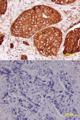 BRCA1 was detected in immersion fixed paraffin-embedded sections of human breast array using Human BRCA1 Monoclonal Antibody (Catalog # MAB22101) at 15 µg/mL overnight at 4 °C. Tissue was stained using the Anti-Mouse HRP-DAB Cell & Tissue Staining Kit (brown; CTS002) and counterstained with hematoxylin (blue). Lower panel shows a lack of labeling if primary antibodies are omitted and tissue is stained only with secondary antibody followed by incubation with detection reagents. View our protocol for Chromogenic IHC Staining of Paraffin-embedded Tissue Sections.