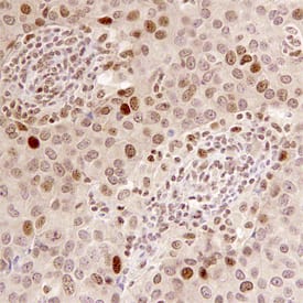 BRIP1/FANCJ was detected in immersion fixed paraffin-embedded sections of human breast cancer tissue using Human BRIP1/FANCJ Monoclonal Antibody (Catalog # MAB6496) at 15 µg/mL overnight at 4 °C. Before incubation with the primary antibody, tissue was subjected to heat-induced epitope retrieval using Antigen Retrieval Reagent-Basic (Catalog # CTS013). Tissue was stained using the Anti-Mouse HRP-DAB Cell & Tissue Staining Kit (brown; Catalog # CTS002) and counterstained with hemotoxylin (blue). Specific staining was localized to nuclei. View our protocol for Chromogenic IHC Staining of Paraffin-embedded Tissue Sections.