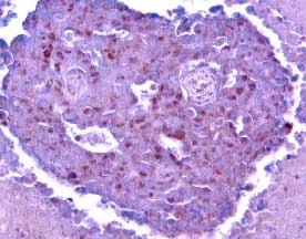 Bcl‑2 was detected in immersion fixed paraffin-embedded sections of human breast cancer tissue using 15 µg/mL Goat Anti-Human/ Mouse Bcl‑2 Antigen Affinity-purified Polyclonal Antibody (Catalog # AF810) overnight at 4 °C. Tissue was stained (red) and counterstained with hematoxylin (blue). View our protocol for Chromogenic IHC Staining of Paraffin-embedded Tissue Sections.