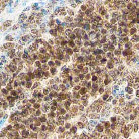 Bcl-2 was detected in immersion fixed paraffin-embedded sections of human lymphoma using Mouse Anti-Human/Mouse/Rat Bcl-2 Monoclonal Antibody (Catalog # MAB8272) at 15 µg/mL overnight at 4 °C. Before incubation with the primary antibody, tissue was subjected to heat-induced epitope retrieval using Antigen Retrieval Reagent-Basic (Catalog # CTS013). Tissue was stained using the Anti-Mouse HRP-DAB Cell & Tissue Staining Kit (brown; Catalog # CTS002) and counterstained with hematoxylin (blue). Specific staining was localized to cytoplasm and nuclei. View our protocol for Chromogenic IHC Staining of Paraffin-embedded Tissue Sections.