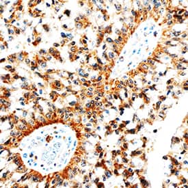 Betacellulin/BTC was detected in immersion fixed paraffin-embedded sections of human lung cancer tissue using Goat Anti-Human Betacellulin/BTC Antigen Affinity-purified Polyclonal Antibody (Catalog # AF-261-NA) at 3 µg/mL overnight at 4 °C. Tissue was stained using the Anti-Goat HRP-DAB Cell & Tissue Staining Kit (brown; CTS008) and counterstained with hematoxylin (blue). Specific staining was localized to cytoplasm. View our protocol for Chromogenic IHC Staining of Paraffin-embedded Tissue Sections.