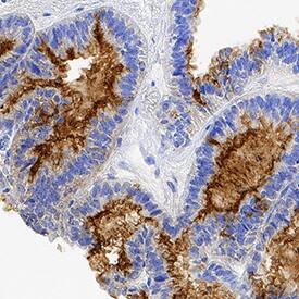 Ovarian Cancer Antigen CA125 (CA125/MUC16) was detected in immersion fixed paraffin-embedded sections of human ovarian cancer tissue using Mouse Anti-Human CA125/MUC16 Monoclonal Antibody (MAB56091) at 5 µg/mL for 1 hour at room temperature followed by incubation with the Anti-Mouse IgG VisUCyte™ HRP Polymer Antibody (VC001). Tissue was stained using DAB (brown) and counterstained with hematoxylin (blue). Specific staining was localized to cell surfaces. View our protocol for IHC Staining with VisUCyte HRP Polymer Detection Reagents.