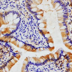 CCL11/Eotaxin was detected in immersion fixed paraffin-embedded sections of human colon using Mouse Anti-Human CCL11/Eotaxin Monoclonal Antibody (Catalog # MAB320) at 15 µg/mL for 1 hour at room temperature followed by incubation with the Anti-Mouse IgG VisUCyte™ HRP Polymer Antibody (Catalog # VC001). Tissue was stained using DAB (brown) and counterstained with hematoxylin (blue). Specific staining was localized to cytoplasm of epithelial and stromal cells. View our protocol for Chromogenic IHC Staining of Paraffin-embedded Tissue Sections.