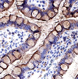 CCL2/JE/MCP-1 was detected in immersion fixed paraffin-embedded sections of human Crohn's disease intestine using Goat Anti-Human CCL2/JE/MCP-1 Antigen Affinity-purified Polyclonal Antibody (Catalog # AF-279-NA) at 25 µg/mL for overnight at 4° C temperature followed by incubation with the Anti-Goat IgG VisUCyte™ HRP Polymer Antibody (Catalog # VC004). Before incubation with the primary antibody, tissue was subjected to heat-induced epitope retrieval using Antigen Retrieval Reagent-Basic (Catalog # CTS013). Tissue was stained using DAB (brown) and counterstained with hematoxylin (blue). Specific staining was localized to epithelial cells. View our protocol for IHC Staining with VisUCyte HRP Polymer Detection Reagents.