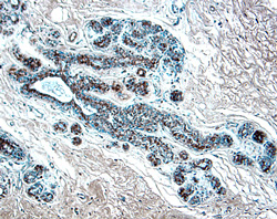 CCL2/JE/MCP-1 was detected in immersion fixed paraffin-embedded sections of human breast cancer tissue using 25 µg/mL Mouse Anti-Human CCL2/JE/MCP-1 Monoclonal Antibody (Catalog # MAB2791) overnight at 4 °C. Tissue was stained with the Anti-Mouse HRP-DAB Cell & Tissue Staining Kit (brown; Catalog # CTS002) and counterstained with hematoxylin (blue). View our protocol for Chromogenic IHC Staining of Paraffin-embedded Tissue Sections.