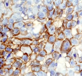CD109 was detected in immersion fixed paraffin-embedded sections of human squamous cell carcinoma using 15 &micro;g/mL Sheep Anti-Human CD109 Antigen Affinity-purified Polyclonal Antibody (Catalog # AF4385) overnight at 4 &deg;C. Tissue was stained with the Anti-Sheep HRP-DAB Cell & Tissue Staining Kit (brown; Catalog # CTS019) and counterstained with hematoxylin (blue). View our protocol for Chromogenic IHC Staining of Paraffin-embedded Tissue Sections.