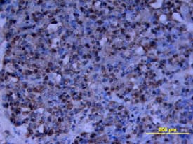 CD24 was detected in immersion fixed paraffin-embedded sections of human ovarian cancer tissue using Human CD24 Monoclonal Antibody (Catalog # MAB5248) at 15 µg/mL overnight at 4 °C. Tissue was stained using the Anti-Mouse HRP-DAB Cell & Tissue Staining Kit (brown; Catalog # CTS002) and counterstained with hematoxylin (blue). View our protocol for Chromogenic IHC Staining of Paraffin-embedded Tissue Sections.
