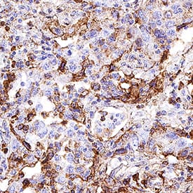 CD63 was detected in immersion fixed paraffin-embedded sections of human lung cancer tissue using Rabbit Anti-Human CD63 Monoclonal Antibody (Catalog # MAB50482) at 0.3 µg/mL for 1 hour at room temperature followed by incubation with the Anti-Rabbit IgG VisUCyte™ HRP Polymer Antibody (VC003). Before incubation with the primary antibody, tissue was subjected to heat-induced epitope retrieval using Antigen Retrieval Reagent-Basic (Catalog # CTS013). Tissue was stained using DAB (brown) and counterstained with hematoxylin (blue). Specific staining was localized to cell membrane in sperm cells. View our protocol for IHC Staining with VisUCyte HRP Polymer Detection Reagents.