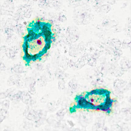<b>Orthogonal Strategies Validation. </b>CD68/SR-D1 mRNA (red) and protein (green) was detected in formalin-fixed paraffin-embedded tissue sections of human tonsil probed with ACD RNAScope®Probe (Catalog # 560591) followed by immunohistochemistry using R&D Systems Mouse Anti-Human CD68/SR-D1 Monoclonal Antibody (Catalog# MAB2040) at 5ug/mL for 1 hour at room temperature followed by incubation with the Anti-Mouse IgG VisUCyte HRP Polymer Antibody (R&D Systems, Catalog # VC001). Tissue was stained using ACD RNAscope® 2.5 HD Duplex Detection Reagents (Catalog # 322500). Specific staining was localized to cytoplasm in lymphocytes.