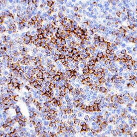 CD8a was detected in immersion fixed paraffin-embedded sections of human tonsil using Mouse Anti-Human CD8a Monoclonal Antibody (Catalog # MAB3801) at 5 µg/mL for 1 hour at room temperature followed by incubation with the Anti-Mouse IgG VisUCyte™ HRP Polymer Antibody (VC001). Before incubation with the primary antibody, tissue was subjected to heat-induced epitope retrieval using Antigen Retrieval Reagent-Basic (CTS013). Tissue was stained using DAB (brown) and counterstained with hematoxylin (blue). Specific staining was localized to cell surfaces in lymphocytes. View our protocol for IHC Staining with VisUCyte HRP Polymer Detection Reagents.
