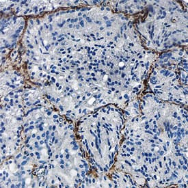 CD90/Thy1 was detected in formalin fixed paraffin-embedded sections of human prostate cancer tissue using Sheep Anti-Human/Porcine/Canine CD90/Thy1 Antigen Affinity-purified Polyclonal Antibody (Catalog # AF2067) at 1.7 µg/mL overnight at 4 °C. Tissue was stained using the Anti-Sheep HRP-DAB Cell & Tissue Staining Kit (brown; Catalog # CTS019) and counterstained with hematoxylin (blue). Specific staining was localized to endothelial cells. View our protocol for Chromogenic IHC Staining of Paraffin-embedded Tissue Sections.
