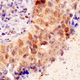 CDK2 was detected in immersion fixed paraffin-embedded sections of human lung cancer tissue using Goat Anti-Human/Mouse CDK2 Antigen Affinity-purified Polyclonal Antibody (Catalog # AF4654) at 3 µg/mL for 1 hour at room temperature followed by incubation with the Anti-Goat IgG VisUCyte™ HRP Polymer Antibody (VC004). Tissue was stained using DAB (brown) and counterstained with hematoxylin (blue). Specific staining was localized to cytoplasm and cancer cell nuclei. View our protocol for IHC Staining with VisUCyte HRP Polymer Detection Reagents.