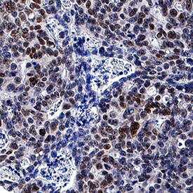CDX2 was detected in immersion fixed paraffin-embedded sections of human colon cancer tissue using Mouse Anti-Human CDX2 Monoclonal Antibody (Catalog # MAB3665) at 5 µg/mL for 1 hour at room temperature followed by incubation with the Anti-Mouse IgG VisUCyte™ HRP Polymer Antibody (Catalog # VC001). Tissue was stained using DAB (brown) and counterstained with hematoxylin (blue). Specific staining was localized to nuclei. View our protocol for IHC Staining with VisUCyte HRP Polymer Detection Reagents.