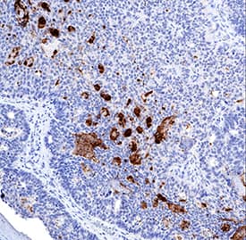 CEACAM-7 was detected in immersion fixed paraffin-embedded sections of human colon cancer tissue using Mouse Anti-Human CEACAM-7 Monoclonal Antibody (Catalog # MAB44781) at 5 µg/mL for 1 hour at room temperature followed by incubation with the Anti-Mouse IgG VisUCyte™ HRP Polymer Antibody (Catalog # VC001). Tissue was stained using DAB (brown) and counterstained with hematoxylin (blue). Specific staining was localized to cytoplasm. View our protocol for IHC Staining with VisUCyte HRP Polymer Detection Reagents.