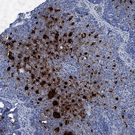 CEACAM-7 was detected in immersion fixed paraffin-embedded sections of human colon cancer tissue using Mouse Anti-Human CEACAM-7 Monoclonal Antibody (Catalog # MAB44782) at 5 µg/mL for 1 hour at room temperature followed by incubation with the Anti-Mouse IgG VisUCyte™ HRP Polymer Antibody (Catalog # VC001). Tissue was stained using DAB (brown) and counterstained with hematoxylin (blue). Specific staining was localized to cytoplasm. View our protocol for IHC Staining with VisUCyte HRP Polymer Detection Reagents.