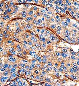 CLEC14A was detected in formalin fixed paraffin-embedded sections of human breast cancer tissue using Sheep Anti-Human CLEC14A Antigen Affinity-purified Polyclonal Antibody (Catalog # AF4968) at 1.7 µg/mL overnight at 4 °C. Before incubation with the primary antibody, tissue was subjected to heat-induced epitope retrieval using Antigen Retrieval Reagent-Universal (Catalog # CTS015). Tissue was stained using the Anti-Sheep HRP-DAB Cell & Tissue Staining Kit (brown; Catalog # CTS019) and counterstained with hematoxylin (blue). Specific staining was localized to endothelial cells. View our protocol for Chromogenic IHC Staining of Paraffin-embedded Tissue Sections.