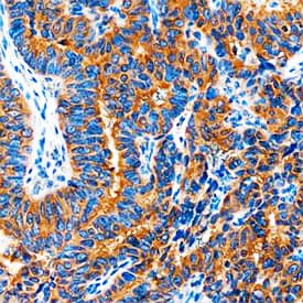 COX-2 was detected in immersion fixed paraffin-embedded sections of human breast cancer tissue using Mouse Anti-Human COX-2 Monoclonal Antibody (Catalog # MAB4198) at 1.7 µg/mL overnight at 4 °C. Tissue was stained using the Anti-Mouse HRP-DAB Cell & Tissue Staining Kit (brown; Catalog # CTS002) and counterstained with hematoxylin (blue). Specific staining was localized to cytoplasm. View our protocol for Chromogenic IHC Staining of Paraffin-embedded Tissue Sections.