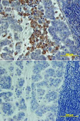 CTGF/CCN2 was detected in immersion fixed paraffin-embedded sections of human pancreas array using Goat Anti-Human CTGF/CCN2 C-Terminus Antigen Affinity-purified Polyclonal Antibody (Catalog # AF660) at 15 µg/mL overnight at 4 °C. Tissue was stained using the Anti-Goat HRP-DAB Cell & Tissue Staining Kit (brown; Catalog # CTS008) and counterstained with hematoxylin (blue). Lower panel shows a lack of labeling if primary antibodies are omitted and tissue is stained only with secondary antibody followed by incubation with detection reagents. View our protocol for Chromogenic IHC Staining of Paraffin-embedded Tissue Sections.
