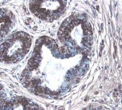 CTGF/CCN2 was detected in immersion fixed paraffin-embedded sections of human breast cancer tissue using 25 &micro;g/mL Human CTGF/CCN2 C-Terminus Monoclonal Antibody (Catalog # MAB660) overnight at 4 &deg;C. Tissue was stained with the Anti-Mouse HRP-DAB Cell & Tissue Staining Kit (brown; Catalog # CTS002) and counterstained with hematoxylin (blue). View our protocol for Chromogenic IHC Staining of Paraffin-embedded Tissue Sections.