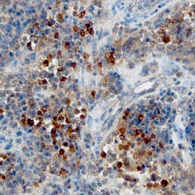 CXCL13/BLC/BCA-1 was detected in immersion fixed paraffin-embedded sections of human lymphoma using Goat Anti-Human CXCL13/BLC/BCA-1 Antigen Affinity-purified Polyclonal Antibody (Catalog # AF801) at 10 µg/mL overnight at 4 °C. Before incubation with the primary antibody, tissue was subjected to heat-induced epitope retrieval using Antigen Retrieval Reagent-Basic (Catalog # CTS013). Tissue was stained using the Anti-Goat HRP-DAB Cell & Tissue Staining Kit (brown; Catalog # CTS008) and counterstained with hematoxylin (blue). Specific staining was localized to cytoplasm. View our protocol for Chromogenic IHC Staining of Paraffin-embedded Tissue Sections.