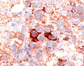 CXCR2/IL-8 RB was detected in immersion fixed paraffin-embedded sections of human lymph node using 15 µg/mL Mouse Anti-Human CXCR2/IL-8 RB Monoclonal Antibody (Catalog # MAB331) overnight at 4 °C. Tissue was stained with the Anti-Mouse HRP-AEC Cell & Tissue Staining Kit (red; Catalog # CTS003) and counterstained with hematoxylin (blue). View our protocol for Chromogenic IHC Staining of Paraffin-embedded Tissue Sections.