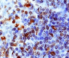 CXCR4 was detected in immersion fixed paraffin-embedded sections of human spleen using Mouse Anti-Human CXCR4 Monoclonal Antibody (Catalog # MAB172) at 15 µg/mL overnight at 4 °C. Before incubation with the primary antibody, tissue was subjected to heat-induced epitope retrieval using Antigen Retrieval Reagent-Basic (Catalog # CTS013). Tissue was stained using the Anti-Mouse HRP-DAB Cell & Tissue Staining Kit (brown; Catalog # CTS002) and counterstained with hematoxylin (blue). Specific staining was localized to cytoplasm and nuclei. View our protocol for Chromogenic IHC Staining of Paraffin-embedded Tissue Sections.