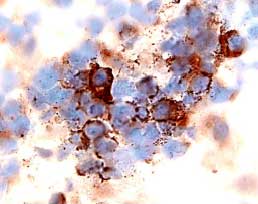 CXCR4 was detected in immersion fixed paraffin-embedded sections of human lymph node using 15 &micro;g/mL Human CXCR4 Monoclonal Antibody (Catalog # MAB172) overnight at 4 &deg;C. Tissue was stained with the Anti-Mouse HRP-AEC Cell & Tissue Staining Kit (red; Catalog # CTS003) and counterstained with hematoxylin (blue). View our protocol for Chromogenic IHC Staining of Paraffin-embedded Tissue Sections.