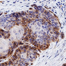 CXCR7/RDC-1 was detected in immersion fixed paraffin-embedded sections of human squamous cell carcinoma using Mouse Anti-Human CXCR7/RDC-1 Monoclonal Antibody (Catalog # MAB42273R) at 5 µg/mL for 1 hour at room temperature followed by incubation with the Anti-Mouse IgG VisUCyte™ HRP Polymer Antibody (Catalog # VC001). Tissue was stained using DAB (brown) and counterstained with hematoxylin (blue). Specific staining was localized to cell surfaces and cytoplasm. View our protocol for IHC Staining with VisUCyte HRP Polymer Detection Reagents.