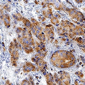 CXCR7/RDC-1 was detected in immersion fixed paraffin-embedded sections of human breast cancer tissue using Mouse Anti-Human CXCR7/RDC-1 Monoclonal Antibody (Catalog # MAB4227R) at 0.5 µg/mL for 1 hour at room temperature followed by incubation with the Anti-Mouse IgG VisUCyte™ HRP Polymer Antibody (Catalog # VC001). Tissue was stained using DAB (brown) and counterstained with hematoxylin (blue). Specific staining was localized to cytoplasm. View our protocol for IHC Staining with VisUCyte HRP Polymer Detection Reagents.