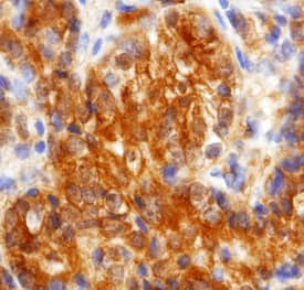 Cadherin-11 was detected in fomralin fixed paraffin-embedded sections of human prostate cancer tissue using Goat Anti-Human Cadherin-11 Antigen Affinity-purified Polyclonal Antibody (Catalog # AF1790) at 15 µg/mL overnight at 4 °C. Tissue was stained using the Anti-Goat HRP-DAB Cell & Tissue Staining Kit (brown; Catalog # CTS008) and counterstained with hematoxylin (blue). Specific staining was localized in the membrane. View our protocol for Chromogenic IHC Staining of Paraffin-embedded Tissue Sections.