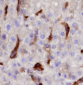 Cadherin‑6/KCAD was detected in immersion fixed paraffin-embedded sections of human liver cancer tissue using 8 &micro;g/mL Mouse Anti-Human Cadherin‑6/KCAD Monoclonal Antibody (Catalog # MAB27151) overnight at 4 &deg;C. Tissue was stained with the Anti-Mouse HRP-DAB Cell & Tissue Staining Kit (brown; Catalog # CTS002) and counterstained with hematoxylin (blue). View our protocol for Chromogenic IHC Staining of Paraffin-embedded Tissue Sections.