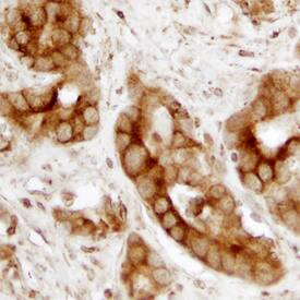 Calreticulin was detected in formalin fixed paraffin-embedded sections of human prostate using Mouse Anti-Human Calreticulin Monoclonal Antibody (Catalog # MAB38981) at 15 µg/mL overnight at 4 °C. Before incubation with the primary antibody, tissue was subjected to heat-induced epitope retrieval using Antigen Retrieval Reagent-Basic (Catalog # CTS013). Tissue was stained using the Anti-Mouse HRP-DAB Cell & Tissue Staining Kit (brown; Catalog # CTS002) and counterstained with hematoxylin (blue). Specific staining was localized to plasma membrane and cytoplasm. View our protocol for Chromogenic IHC Staining of Paraffin-embedded Tissue Sections.