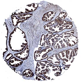Calreticulin was detected in immersion fixed paraffin-embedded sections of human prostate using Mouse Anti-Human Calreticulin Monoclonal Antibody (Catalog # MAB38982) at 15 µg/mL for 1 hour at room temperature followed by incubation with the Anti-Mouse IgG VisUCyte™ HRP Polymer Antibody (Catalog # VC001). Before incubation with the primary antibody, tissue was subjected to heat-induced epitope retrieval using Antigen Retrieval Reagent-Basic (Catalog # CTS013). Tissue was stained using DAB (brown) and counterstained with hematoxylin (blue). Specific staining was localized to cytoplasm. View our protocol for IHC Staining with VisUCyte HRP Polymer Detection Reagents.