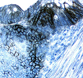 Carbonic Anhydrase IX/CA9 was detected in immersion fixed paraffin-embedded sections of human colon cancer tissue using Goat Anti-Human Carbonic Anhydrase IX/CA9 Antigen Affinity-purified Polyclonal Antibody (Catalog # AF2188) at 15 µg/mL overnight at 4 °C. Tissue was stained using the Anti-Goat HRP-DAB Cell & Tissue Staining Kit (brown; CTS008) and counterstained with hematoxylin (blue). Specific labeling was localized to the plasma membrane of epithelial cells. View our protocol for Chromogenic IHC Staining of Paraffin-embedded Tissue Sections.