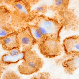 Carboxypeptidase M was detected in immersion fixed paraffin-embedded sections of human placenta using Sheep Anti-Human Carboxypeptidase M Antigen Affinity-purified Polyclonal Antibody (Catalog # AF7457) at 10 µg/mL overnight at 4 °C. Before incubation with the primary antibody, tissue was subjected to heat-induced epitope retrieval using Antigen Retrieval Reagent-Basic (Catalog # CTS013). Tissue was stained using the Anti-Sheep HRP-DAB Cell & Tissue Staining Kit (brown; Catalog # CTS019) and counterstained with hematoxylin (blue). Specific staining was localized to the plasma membrane of decidual cells. View our protocol for Chromogenic IHC Staining of Paraffin-embedded Tissue Sections.
