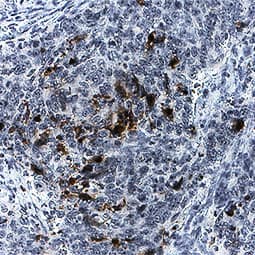 Caspase-3 was detected in immersion fixed paraffin-embedded sections of human colon cancer tissue using Rabbit Anti-Human/Mouse Active Caspase-3 Antigen Affinity-purified Polyclonal Antibody (Catalog # AF835) at 1 µg/mL for 1 hour at room temperature followed by incubation with the Anti-Rabbit IgG VisUCyte™ HRP Polymer Antibody (Catalog # VC003). Before incubation with the primary antibody, tissue was subjected to heat-induced epitope retrieval using Antigen Retrieval Reagent-Basic (Catalog # CTS013). Tissue was stained using DAB (brown) and counterstained with hematoxylin (blue). Specific staining was localized to cytoplasm and nucleus. View our protocol for IHC Staining with VisUCyte HRP Polymer Detection Reagents.