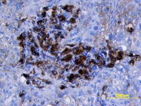 Cathepsin D was detected in immersion fixed paraffin-embedded sections of human lung cancer tissue using Goat Anti-Human Cathepsin D Antigen Affinity-purified Polyclonal Antibody (Catalog # AF1014) at 15 µg/mL overnight at 4 °C. Tissue was stained using the Anti-Goat HRP-DAB Cell & Tissue Staining Kit (brown; Catalog # CTS008) and counterstained with hematoxylin (blue). View our protocol for Chromogenic IHC Staining of Paraffin-embedded Tissue Sections.