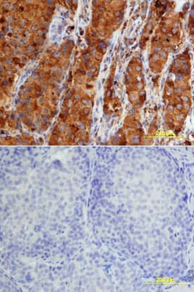 Cathepsin D was detected in immersion fixed paraffin-embedded sections of human lung array using Goat Anti-Human Cathepsin D Biotinylated Antigen Affinity-purified Polyclonal Antibody (Catalog # BAF1014) at 15 µg/mL overnight at 4 °C. Tissue was stained using the Anti-Goat HRP-DAB Cell & Tissue Staining Kit (brown; Catalog # CTS008) and counterstained with hematoxylin (blue). Lower panel shows a lack of labeling if primary antibodies are omitted and tissue is stained only with secondary antibody followed by incubation with detection reagents. View our protocol for Chromogenic IHC Staining of Paraffin-embedded Tissue Sections.