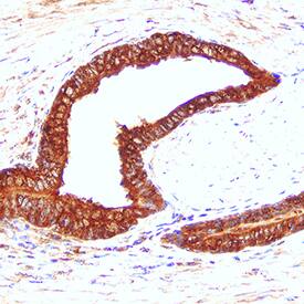 Cathepsin D was detected in immersion fixed paraffin-embedded sections of human prostate cancer tissue using Mouse Anti-Human Cathepsin D Monoclonal Antibody (Catalog # MAB1014) at 5 µg/mL for 1 hour at room temperature followed by incubation with the Anti-Mouse IgG VisUCyte™ HRP Polymer Antibody (Catalog # VC001). Tissue was stained using DAB (brown) and counterstained with hematoxylin (blue). Specific staining was localized to epithelial cell cytoplasm. View our protocol for IHC Staining with VisUCyte HRP Polymer Detection Reagents.