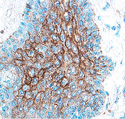 Cathepsin V was detected in immersion fixed paraffin-embedded sections of human breast cancer tissue using 1.7 &micro;g/mL Goat Anti-Human Cathepsin V Antigen Affinity-purified Polyclonal Antibody (Catalog # AF1080) overnight at 4 &deg;C. Tissue was stained with the Anti-Goat HRP-DAB Cell & Tissue Staining Kit (brown; Catalog # CTS008) and counterstained with hematoxylin (blue). View our protocol for Chromogenic IHC Staining of Paraffin-embedded Tissue Sections.