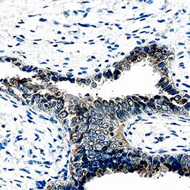 Chitinase 3-like 1/YKL-40 was detected in immersion fixed paraffin-embedded sections of human ovarian cancer using Goat Anti-Human Chitinase 3-like 1/YKL-40 Antigen Affinity-purified Polyclonal Antibody (Catalog # AF2599) at 15 µg/mL overnight at 4 °C. Before incubation with the primary antibody, tissue was subjected to heat-induced epitope retrieval using Antigen Retrieval Reagent-Basic (CTS013). Tissue was stained using the Anti-Goat HRP-DAB Cell & Tissue Staining Kit (brown; CTS008) and counterstained with hematoxylin (blue). Specific staining was localized to epithelial cells. View our protocol for Chromogenic IHC Staining of Paraffin-embedded Tissue Sections.