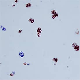 Chitinase 3-like 1/YKL-40 was detected in immersion fixed paraffin-embedded sections of human cartilage using Goat Anti-Human Chitinase 3-like 1/YKL-40 Antigen Affinity-purified Polyclonal Antibody (Catalog # AF2599) at 15 µg/mL overnight at 4 °C. Tissue was stained using the Anti-Goat HRP-DAB Cell & Tissue Staining Kit (brown; CTS008) and counterstained with hematoxylin (blue). Specific staining was localized to chondrocytes. View our protocol for Chromogenic IHC Staining of Paraffin-embedded Tissue Sections.
