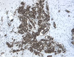 Chordin-like 2/CHRDL2 was detected in immersion fixed paraffin-embedded sections of human breast cancer tissue using 15 &micro;g/mL Goat Anti-Human Chordin-like 2/CHRDL2 Antigen Affinity-purified Polyclonal Antibody (Catalog # AF2448) overnight at 4 &deg;C. Tissue was stained with the Anti-Goat HRP-DAB Cell & Tissue Staining Kit (brown; Catalog # CTS008) and counterstained with hematoxylin (blue). View our protocol for Chromogenic IHC Staining of Paraffin-embedded Tissue Sections.
