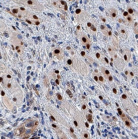 Cyclin B1 was detected in immersion fixed paraffin-embedded sections of human squamous cell carcinoma using Rabbit Anti-Human Cyclin B1 Monoclonal Antibody (Catalog # MAB60001) at 3 µg/mL for 1 hour at room temperature followed by incubation with the Anti-Rabbit IgG VisUCyte™ HRP Polymer Antibody (Catalog # VC003). Tissue was stained using DAB (brown) and counterstained with hematoxylin (blue). Specific staining was localized to nuclei. View our protocol for IHC Staining with VisUCyte HRP Polymer Detection Reagents.