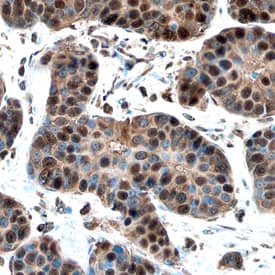Cyclin E1 was detected in immersion fixed paraffin-embedded sections of human breast using Sheep Anti-Human Cyclin E1 Antigen Affinity-purified Polyclonal Antibody (Catalog # AF6810) at 10 µg/mL overnight at 4 °C. Before incubation with the primary antibody, tissue was subjected to heat-induced epitope retrieval using Antigen Retrieval Reagent-Basic (CTS013). Tissue was stained using the Anti-Sheep HRP-DAB Cell & Tissue Staining Kit (brown CTS019) and counterstained with hematoxylin (blue). Specific staining was localized to nuclei. View our protocol for Chromogenic IHC Staining of Paraffin-embedded Tissue Sections.