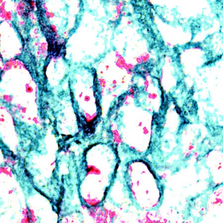 Cytokeratin 19 mRNA (red) and protein (green) was detected in formalin-fixed paraffin-embedded tissue sections of human breast cancer tissue probed with ACD RNAScope®Probe (Catalog # 310221) followed by immunohistochemistry using R&D Systems Mouse Anti-Human Cytokeratin 19 Monoclonal Antibody (Catalog # MAB35061) at 15ug/mL for 1 hour at room temperature followed by incubation with the Anti-Mouse IgG VisUCyte HRP Polymer Antibody (R&D Systems, Catalog # VC001). Tissue was stained using ACD RNAscope®2.5 HD Duplex Detection Reagents (Catalog # 322500).