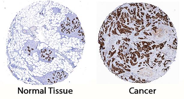 Cytokeratin 19 was detected in immersion fixed paraffin-embedded sections of human breast cancer tissue using Mouse Anti-Human Cytokeratin 19 Monoclonal Antibody (Catalog # MAB35061) at 5 µg/mL for 1 hour at room temperature followed by incubation with the Anti-Mouse IgG VisUCyte™ HRP Polymer Antibody (Catalog # VC001). Tissue was stained using DAB (brown) and counterstained with hematoxylin (blue). Specific staining was localized to cytoplasm. View our protocol for IHC Staining with VisUCyte HRP Polymer Detection Reagents.